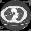 2017 03 01 15 23 43 165 Sa5 Lung Cancer Screening Image 20170301222409