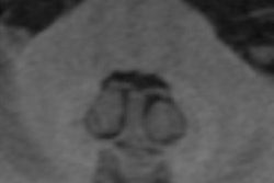 2017 03 02 17 51 10 177 2017 03 03 Gadolinium Thumb 20170303005132
