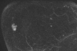 2017 03 04 12 40 22 555 2017 03 05 Breast Mri Thumb2