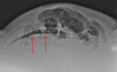 Cross-table lateral radiograph of the abdomen. Evidence of a translucent image was not correctly interpreted as pneumoperitoneum. Image courtesy of Dr. Antonio Pinto.