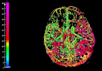 In the 3D volume rendering above, the reader can see a patient-specific color map, indicating the arrival time of blood to the brain. The color difference between the left and right hemisphere is caused by a vascular occlusion in the M1 segment. Due to collateral flow, the affected hemisphere is supplied with blood at a later arrival time, with orange and red hues indicating contrast arrival times several seconds later than green and blue. The green image below lacks color coding and took longer to interpret. Images courtesy of Midas Meijs.