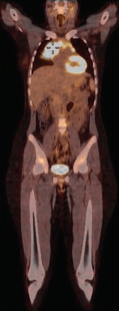 FDG-PET/CT of a 15-year-old girl with a mediastinal mass who was a candidate for biopsy and histopathologic investigation. The coronal fused PET/CT indicates an FDG-avid tumor (cursor) in the mediastinum. Image courtesy of AJR.