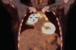 2017 03 06 11 31 38 851 Coronal Pet Ct Mol Insider Image 200