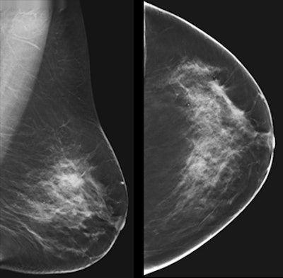 A 63-year-old woman with bilateral breast pain for two months. Both breasts were normal on clinical evaluation. In the outer quadrant of the left breast, a subtle spiculated mass, measuring 16 mm, is seen on craniocaudal view that is not well-visualized on mediolateral oblique view, but it is better demonstrated on tomosynthesis. Courtesy of Dr. Fiona Gilbert, University of Cambridge, U.K. Originally published in ECR Today 2017.