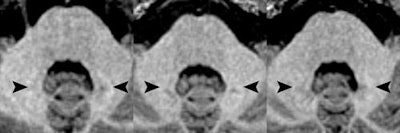 Axial MR images of a patient before (left) and after four (middle) and eight (right) administrations of the macrocyclic GBCA gadoterate meglumine. Location of the hyperintense dentate nucleus (arrowheads) is evident, with the patient's pre-existing hyperintensities due to 14 prior administrations of linear GBCAs. Images courtesy of Radiology.