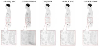 Reconstructed sagittal images with different levels of quantitative correction. Left to right: true activity map; all events with no correction (T+S+R w/o correction); true events only with resolution modelling (T-only w/ RM); all events with scatter and random correction (T+S+R w/ sc+rc); and all events with scatter and random correction plus resolution modelling (T+S+R w/ sc+rc+RM).