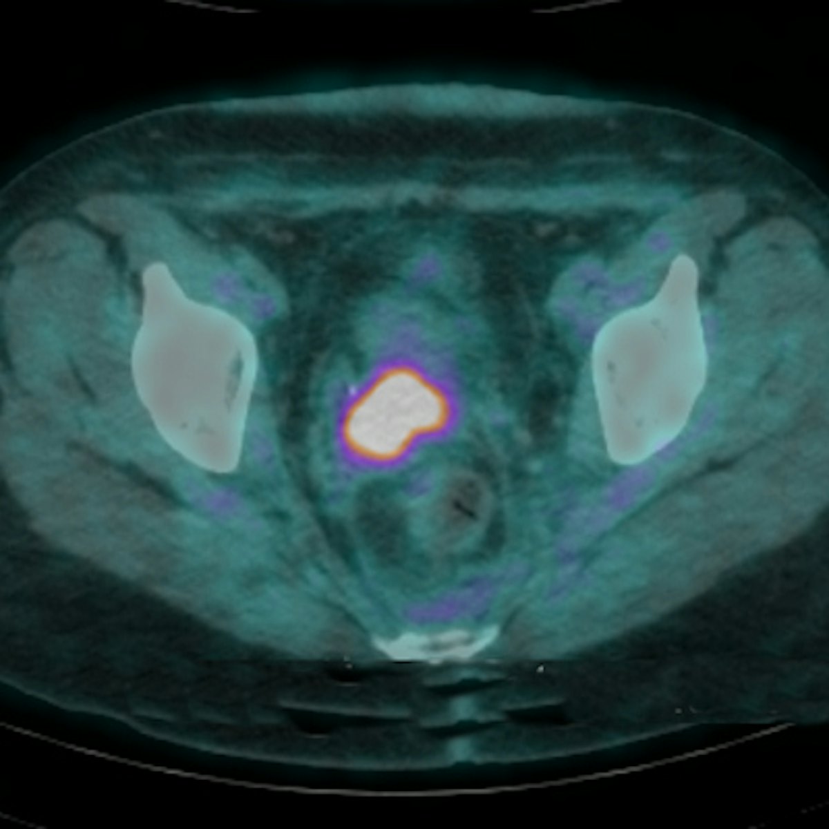 FDG-PET/CT scoring system aids in cervical cancer prognosis ...