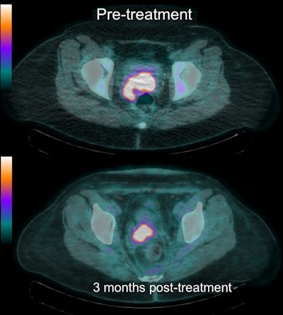These FDG-PET/CT images show baseline (top) and follow-up (bottom) results in a patient with significant residual (grade 5) uptake in the primary tumor after treatment. The finding was confirmed to represent residual tumor histologically and the patient underwent successful salvage surgery.