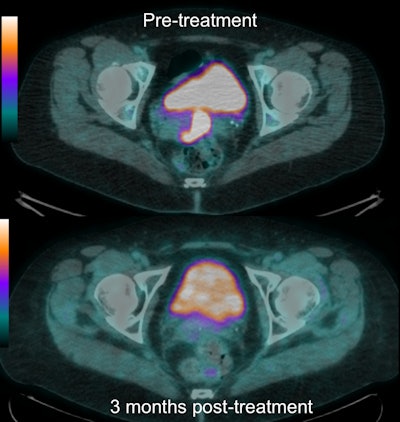FDG-PET/CT images show shows baseline (top) and follow-up (bottom) results in a patient who had a complete metabolic response (grade 1) in the primary tumor. All images courtesy of Dr. Andrew Scarsbrook.