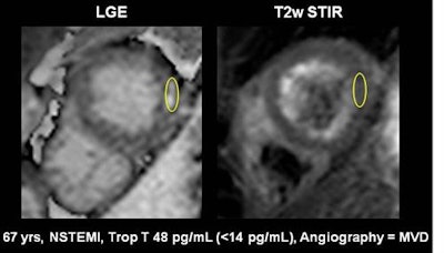 A 67-year-old male patient presenting with non-ST-elevated myocardial infarction (NSTEMI) and moderately elevated troponins, had multivessel disease on invasive angiography. Top image: Late gadolinium enhancement is visible at the lateral wall of the apex in CMR. To distinguish acute from chronic myocardial infarction (MI), the standard approach is to acquire a signal intensity (SI) value from the myocardium, build a ratio with the SI value from a skeletal muscle region of interest, and determine from the previously established cutoff whether the MI is acute or chronic. In this case, the SI was 3.4 (image below), which is above previously established cutoff meaning acute infarction per the standard method. However, CMR TI mapping (below) shows a value of 1020, well under the cutoff of 1037, revealing a chronic infarction requiring no intervention. All images courtesy of Dr. Emver Tahir.