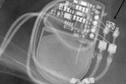 2011 04 05 11 07 59 848 2011 04 06 Pacemaker 20140521164608