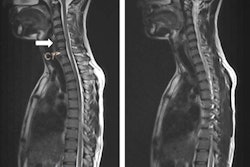 2017 04 05 12 35 19 649 2017 04 06 Spinal Mri Thumb