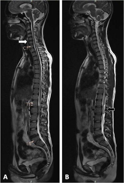 This 42-year-old male patient presented with axial neck pain and right upper-limb radiculopathy. Whole-spine T2-weighted sagittal screening images (a, b) show mild disk bulge at C5-6 (white arrow), and an intradural extramedullary tumor behind the body of L1 vertebra (black arrow). Image courtesy of Dr. Rishi Kanna and European Spine Journal.