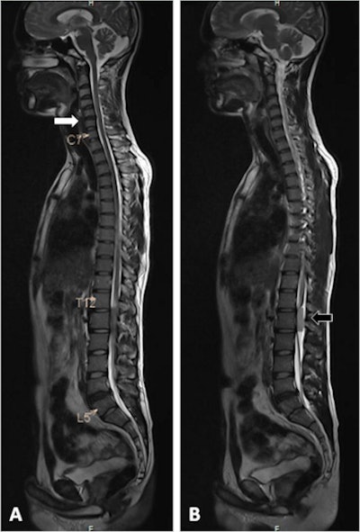 This 42-year-old male patient presented with axial neck pain and right upper-limb radiculopathy. Whole-spine T2-weighted sagittal screening images (a, b) show mild disk bulge at C5-6 (white arrow), and an intradural extramedullary tumor behind the body of L1 vertebra (black arrow). Image courtesy of Dr. Rishi Kanna and European Spine Journal.