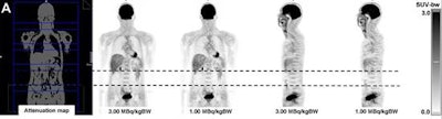 FDG-PET images show good image quality in a 43-year-old patient with a dose of 1 MBq/kgBW (A). However, there was an artifact in the abdominal region (B) at lower doses. This region was located completely within one bed position (dotted line). Images courtesy of JNM.