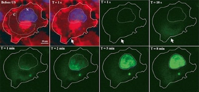Time series of confocal images, showing cell membrane in red and the nucleus in blue; the white arrow shows the pore created by ultrasound, the SYTOX Green uptake is shown in green. Ultrasound was turned on for 5 second at T = 0. Image courtesy of Bart Lammertink, Clemens Bos, PhD, and colleagues.