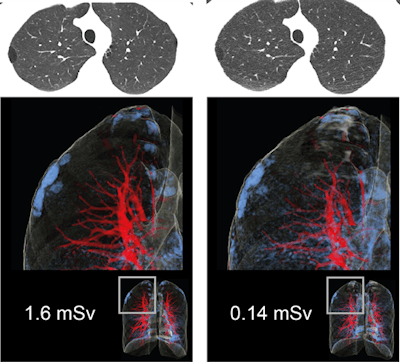 CT images of the lung in a 27-year-old man with a body mass index of 20.6 kg/m2. He was scanned, after spontaneous pneumothorax, with standard dose (left column) and ultralow-dose (right column). LAA in blue represent paraseptal emphysema (zoomed in right upper lobe). The extent and distribution of emphysema is equally recognizable in chest x-ray equivalent ultralow-dose at 0.14 mSv CT compared with standard dose CT.