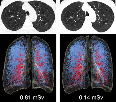 CT images of the lung in a 48-year-old woman with emphysema. She had a body mass index of 17.6 kg/m2, and was scanned with standard dose (left column) and ultralow dose (right column). Low attenuation areas (LAA) in blue represent emphysematous lung changes. The extent and distribution of emphysema is equally recognizable in chest x-ray equivalent ultralow-dose at 0.14 mSv CT compared with standard dose CT. All images courtesy of Dr. Michael Messerli.