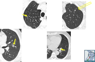 Initial aspects of malignant lesions in the ITALUNG study: squamous adenocarcinomas. Image courtesy of Drs. Mario Mascalchi, Fabio Falaschi, and Giulia Picozzi.