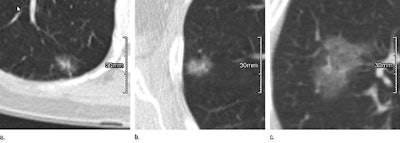 CT scans of subsolid nodules for which upgrade to category 4X was determined variably by the six observers. (a, left) Malignant lesion upgraded by three observers. (b, middle) Malignant lesion upgraded by four observers. (c, right) Benign lesion upgraded by two observers. Images republished with permission of RSNA from Chung et al, Radiology, March 24, 2017.