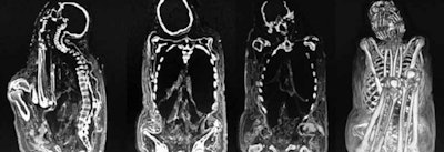 Mummification in a dry and warm area. The internal organs are dehydrated, have lost volume, and are very retracted, with the exception of the skin. All images courtesy of Dr. Jorge Luis Guerrero Gil.