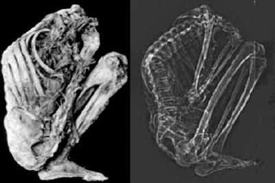 Note the typical deformation of the dorsal spine caused by Pott's disease.