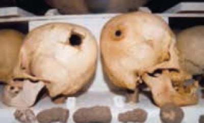 Note the trephine hole with irregular and growing edges, indicating that the patient survived and the wound healed.