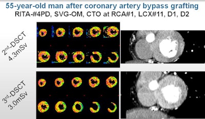 Dynamic perfusion CT of a 55-year-old man after coronary artery bypass grafting. Z-axis coverage of 10.5 cm in the third-generation scanner was sufficient to cover the entire left-ventricular myocardium. Left-ventricular atheroma at myocardium reveals similar perfusion on the anterior and inferior walls, but radiation dose was 30% lower (3.0 mSv) at third-generation DSCT. Images courtesy of Dr. Kakuya Kitagawa, PhD.