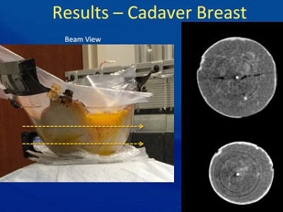 Beam view of cadaver breast shows image artifacts.