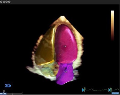 Philips HeartModelA.I. provides automated 3D analysis of echocardiography images. Image courtesy of Philips.