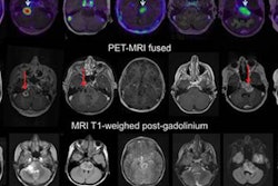 2017 05 03 10 15 32 328 Pet Ct Mri Jnm 20170503171557