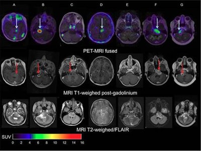 Images of pediatric patients with DIPG show results from Zr-89-bevacizumab PET fused with T1 gadolinium-weighted MRI per patient (top row); T1 gadolinium-weighted MRI (middle row); and T2-weighted/fluid-attenuated inversion recovery (FLAIR) MRI (bottom row). Five tumors show variable uptake of Zr-89 bevacizumab (white arrows), with both PET-negative and PET-positive areas within each tumor. Image courtesy of Sophie Veldhuijzen van Zanten and Marc Jansen, VU University Medical Center.