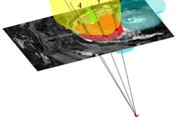 2017 05 12 11 44 26 274 2017 05 15 Brachy Needles Fig3ab Thumb