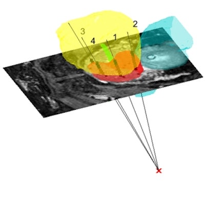 2017 05 12 11 44 26 274 2017 05 15 Brachy Needles Fig3ab Thumb