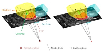 Final needle trajectories and dwell positions for a typical patient resulting from one simulation in the situation of optimal (a) and least optimal (b) needle insertion sequence. The order of needle insertion is depicted at the tip of the needle.