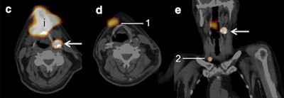 SPECT/CT (c, d, e) shows additional sentinel lymph nodes (arrows) on the tongue, with planar lymphoscintigraphy indicating postinjection spot (i). Due to the high amount of tracer uptake on SPECT/CT, exploration with the gamma probe was performed during surgery, during which three sentinel lymph nodes were identified (1, 2). Images courtesy of EJNMMI.