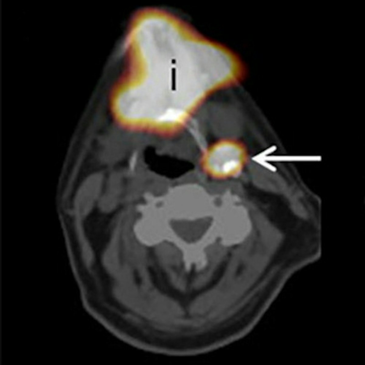 SPECT/CT advances routine oral cancer assessment | AuntMinnieEurope