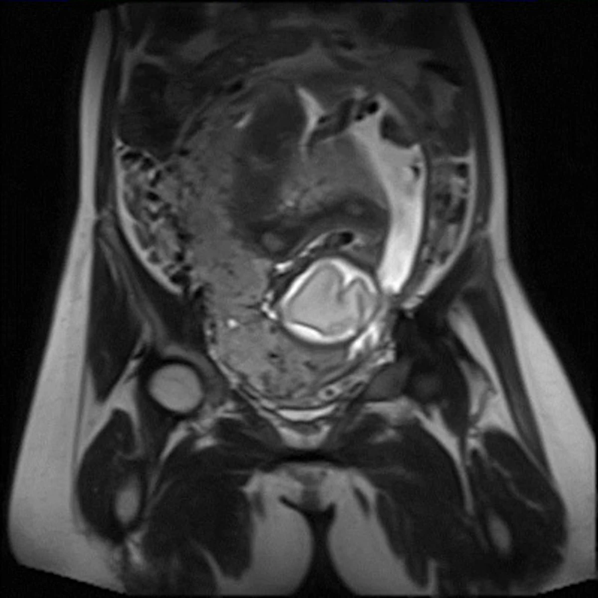 MRI shows true value in invasive placenta AuntMinnieEurope