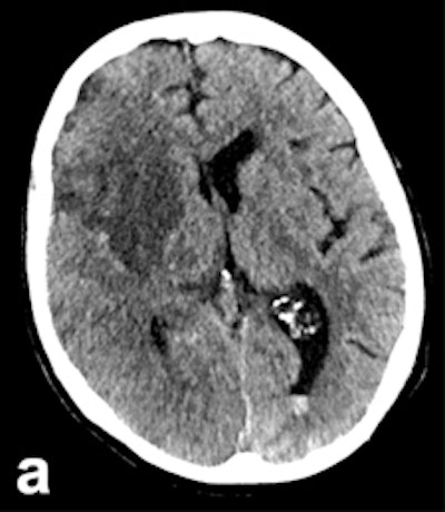 2017 05 25 09 15 41 699 2017 05 25 Stroke Herweh 3a 225