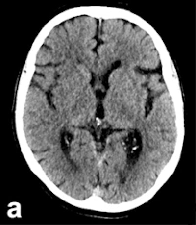 2017 05 25 09 15 43 354 2017 05 25 Stroke Herweh 1a 225