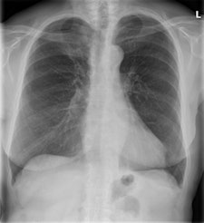 Preoperative posteroanterior chest radiograph of a 79-year old woman