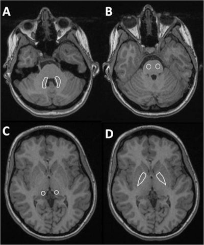 Sample images of four of the measured regions: A = dentate nucleus, B = pons, C = pulvinar, D = globus pallidus. All images courtesy of Dr. Dirk Klee and the German Radiological Society.