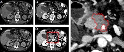 A comparison of images using conventional CT (A and B) and spectral MonoE 40-keV images (C and D) in the arterial and venous portal contrast medium phases. The images show a pancreatic carcinoma with encasement of the superior mesenteric artery. The tumor boundaries can be seen much more clearly in C and D. E shows the detail, with tumor boundary marked. All images courtesy of the German Radiological Society.