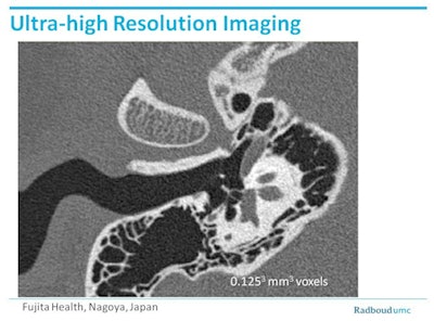 Example from a prototype Toshiba scanner (Aquilion Precision) shows the status of an inner ear at 0.125. Tiny electrodes that could not have been visualized on standard CT are clearly visible. Image courtesy of Dr. Mathias Prokop and Fujita Health, Nagoya, Japan.