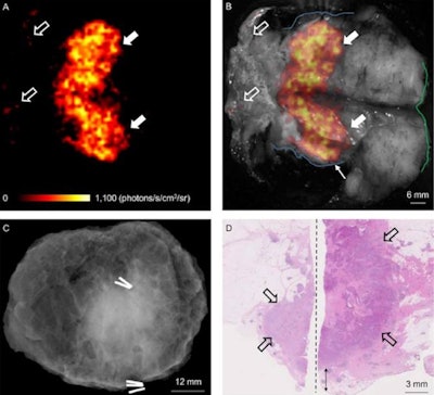 Image set comes from a patient with grade 3, ER-/HER2-, no special type carcinoma and includes the Cerenkov image (A) and a grayscale photographic image (B) overlaid with Cerenkov signal. An increased signal from the tumor is visible (white arrows). Both surgeons measured the posterior margin (outlined in blue) as 2 mm (small arrow) and the medial margin (outlined in green), which measured more than 5 mm. A phosphorescent signal also is visible (open arrows), along with specimen radiography image (C). The absence of one surgical clip to mark the anterior margin, and the odd position of the superior margin clip (white arrow) prevented reliable margin assessment. A combined histopathology image (D) from two adjacent pathology slides on which the posterior margin (bottom of image) and part of the primary tumor are visible (open arrows). The distance from the posterior margin measured 3 mm microscopically (double arrow). Images courtesy of the Journal of Nuclear Medicine.