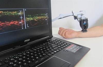 A newly developed tissue scanner allows visualization of the structure of skin layers and blood vessels under the skin of psoriasis patients. Image courtesy of Helmholtz Zentrum München.