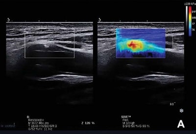 (A, above) Carotid plaque classified as Gray-Weale Type II shown with a B-mode and shear-wave elastography image. (B, below) The Young's modulus value of the plaque located in the anterior of the internal carotid artery was obtained using the Q-Box-Trace software tool. All images courtesy of the Journal of Ultrasound in Medicine.