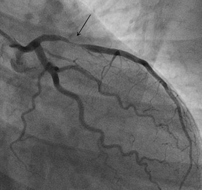 Invasive coronary angiography of the same patient. The black arrow shows a very tight narrowing in the proximal left anterior descending artery.