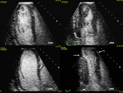 Exercise stress echocardiography with ultrasound contrast agent. Top row: Rest images in diastole (left) and systole (right; there is some contrast swirling due to lower cardiac output at rest). Bottom row: Peak stress images in diastole (left; note the dilatation of the left ventricle) and systole (right; note that the apical segments become severely hypokinetic -- white arrows). All images courtesy of Dr. Alexandros Papachristidis.