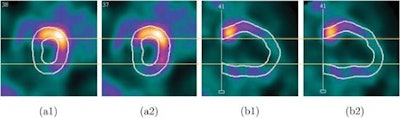 Screenshots of end systolic heart images in short-axis view (a) and vertical long-axis view (b), without (1) and with (2) respiratory motion correction, from the patient 1 study.